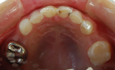 MT銀歯