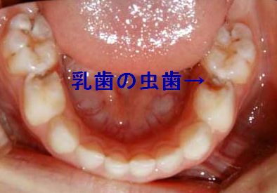 MT虫歯